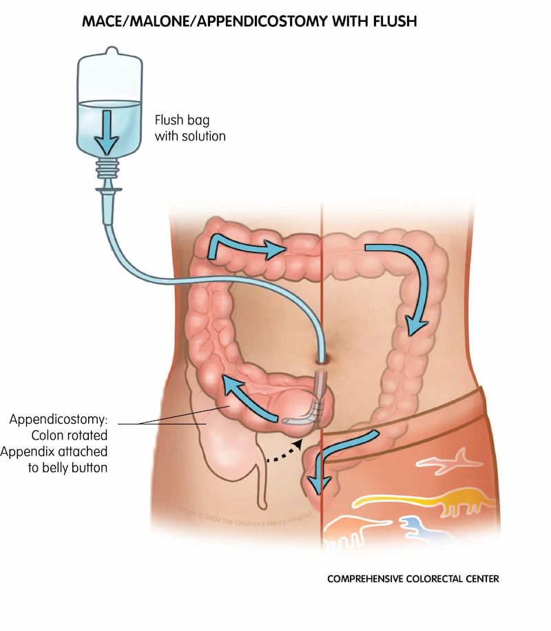 Living with MACE Bowel Washouts: A Parent's Perspective